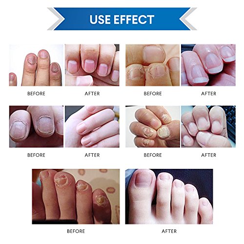 Fungus Stop, Anti-Fungal Nail Pen - Kill Fungus, Remove Discoloration, Prevent Future Infection, Repair Brittle Fingernails and Toenails 2 Pcs