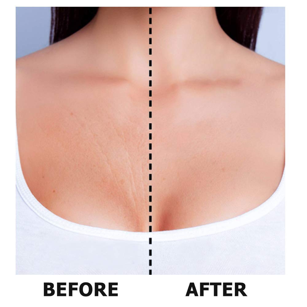 El parche antiarrugas para el escote, MS.DEAR almohadillas antiarrugas hechas de silicona de grado médic para la eliminación y eliminación de arrugas de piel y escote y reduce las líneas finas