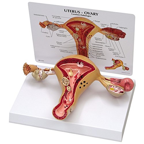 Uterus Ovary Anatomical Model With Pathologies - Thumbnail 2