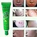 ULAKY Removal Blemish Facial Effective Acne Treatments Gel Care Face Skin Cream Pure & Clear Acne Treatment Gel
