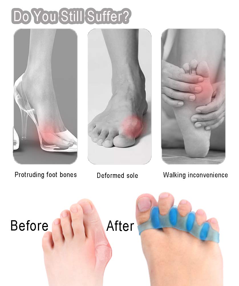 Alivonao Gel Toe Separators and Toe Streightener to Correct Bunions, Relaxing Toes, Hammer Toe Universal Size Suitable for Men and Women : Beauty