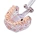 Easyinsmile Dental Pathology Model Half Implant Tooth Model for Dentist Studying Researching and Patient Education