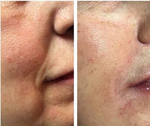 sunkissed acne serum