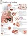 Effects of Smoking Educational Chart Poster 22 x 28in
