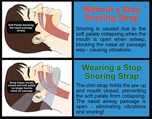 image for Aleeza Stop Snoring Chin Strap (SPECIAL RELIEF BUNDLE) - Includes: Ant