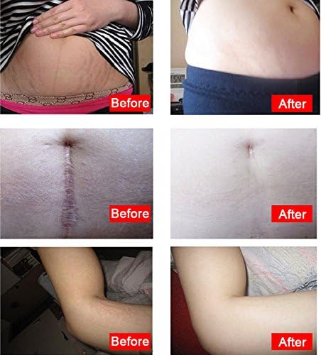 Remove Stretch marks essential oil postpartum obesity pregnancy repairing cream (Pack of 2 boxes)