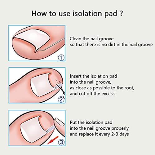 Ingrown Toenail Treatment Includes 60 PCS of Ingrown Toenail Corrector