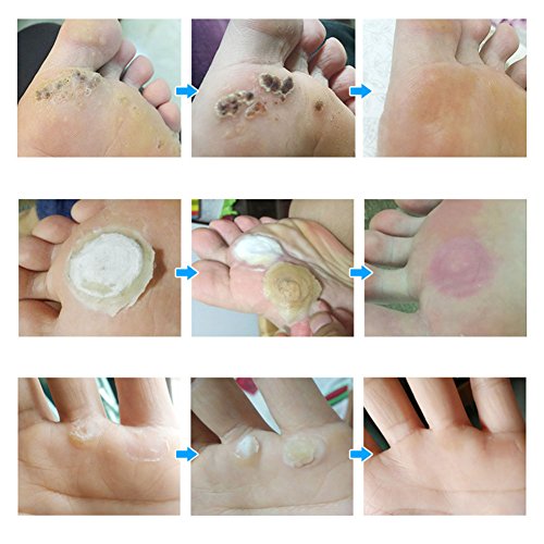 Wart Remover, Plantar Wart Remover, Wart Removal, Corn Remover, Wart Removal Pen with Natural Ingredients, Penetrates and Remove Plantar Warts, Corns, Callus, Stops Wart Regrowth, 5mlX2 - Thumbnail 6