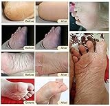 CGBOOM 3 Pack Foot Peel Mask Rose Exfoliating Socks Callus Remover Dry Cracked view 8