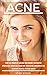 Acne: The Ultimate Guide On How To Both Prevent And Get Rid Of Your Blemishes To Regain Your Clear S by Stan Kozak