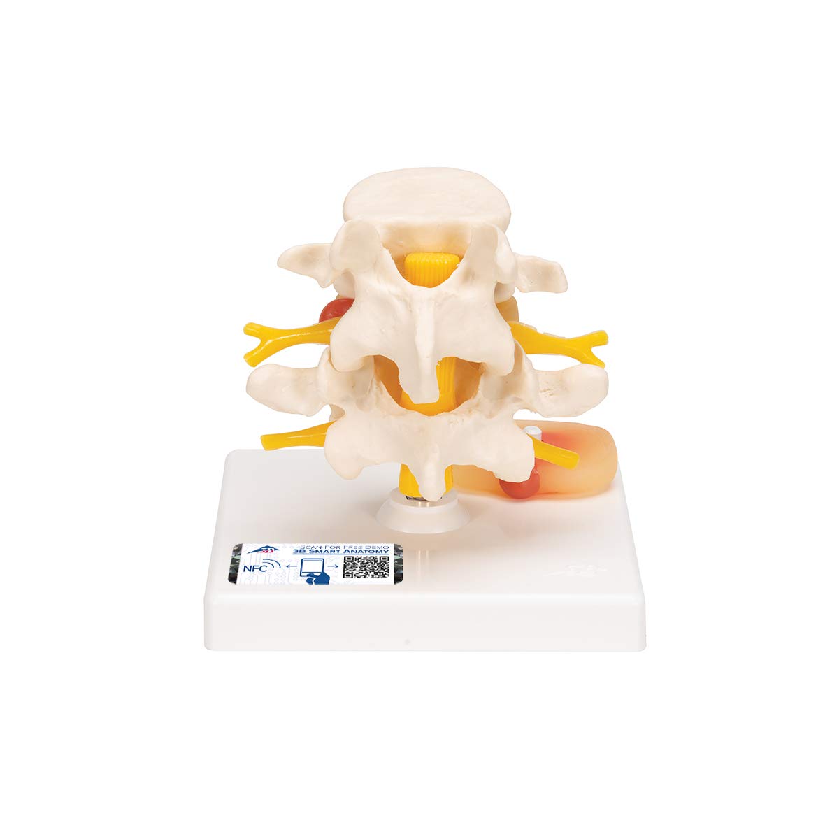 3B Scientific Lumbar Spinal Column with Prolapsed InterVertebral Disc + free anatomy software - 3B Smart Anatomy