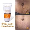 Cicatrissim Stretch Marks Removal Cream - Innovative Natural Formula With Pure and Potent Ingredients From Brazilian…