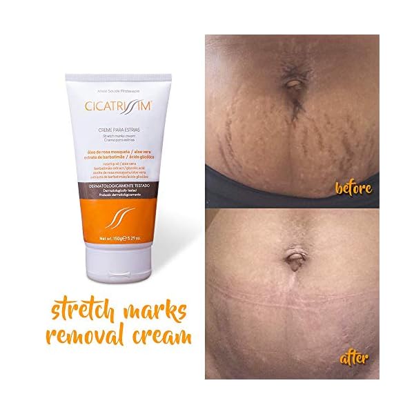 Cicatrissim Stretch Marks Removal Cream - Innovative Natural Formula With Pure and Potent Ingredients From Brazilian…