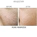 Aria Starr Anti Acne Treatment Serum & Pores Minimizer - BEST For Face, Stubborn Acne, Blackheads & Blemishes -1fl oz
