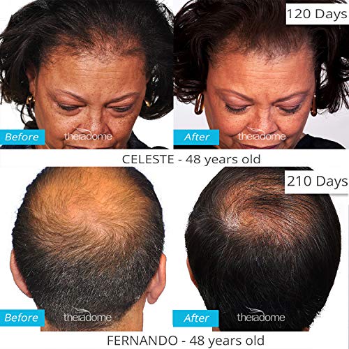 Theradome PRO LH80 Hair Growth Helmet - Image 8
