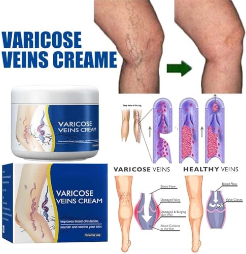 LBOYLOVE® 2 PCS Varicose Veins Cream for Legs, Spider Varicose Veins ReliefCream, SkinCream for Legs, Cream for VaricoseVeins