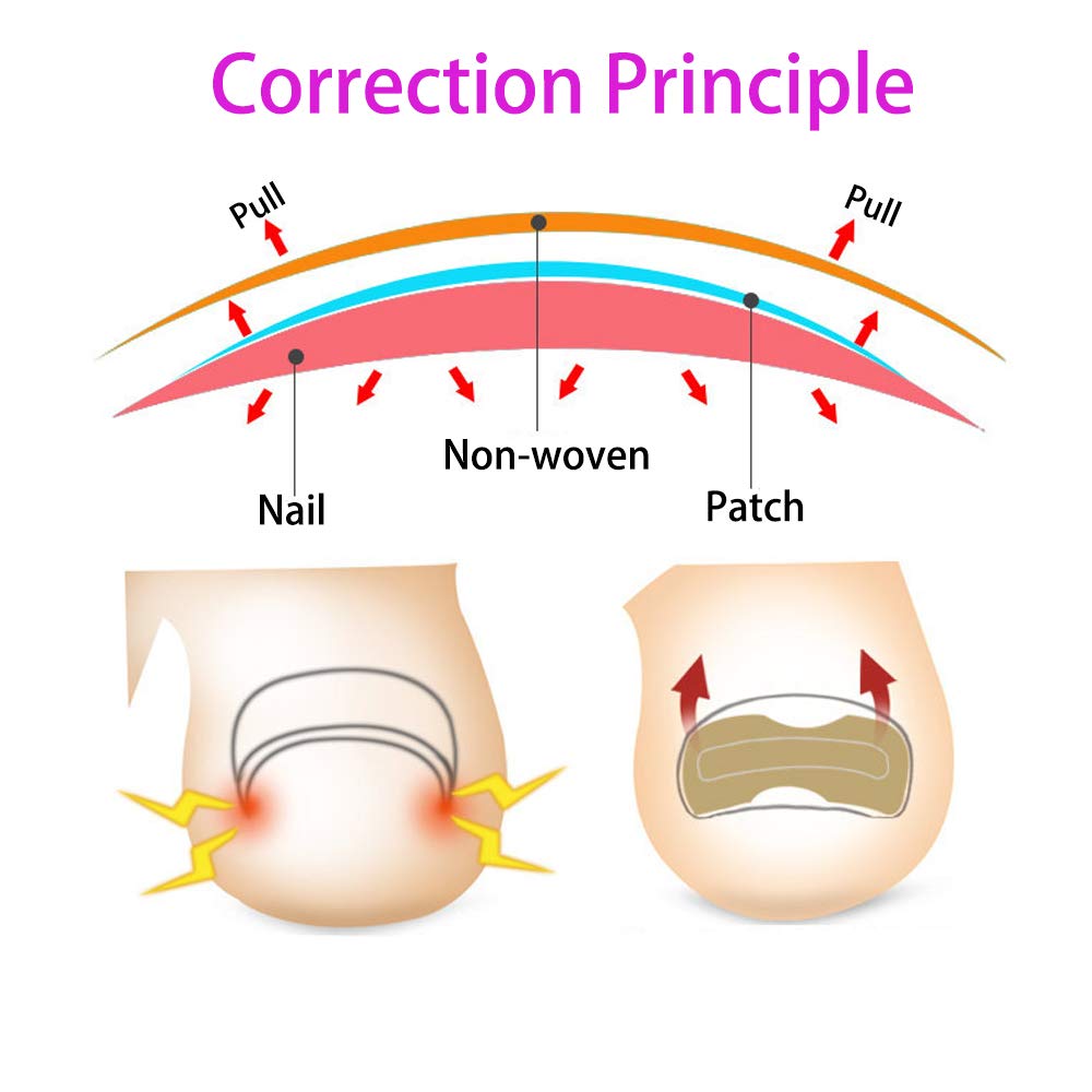 3 Set Glue Free Toenail Patch - Ingrown Toenail Correction Sticker Professional Pedicure for Men Women Toenail Care Tool: Beauty