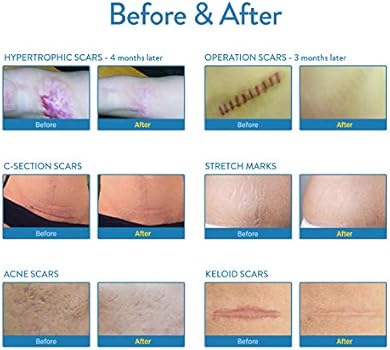 Aroamas Silicone Scar Removal Sheets For Keloid C Section Hypertrophic Surgical Scars And More Reusable And Washable 3 1 57 4 Sheets 2 Month Supply Buy Online At Best Price In Uae Amazon Ae