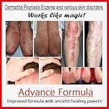 Spirit Natural Chinese Antibacterial Herbal Ointment Cream Dermatitis Psoriasis Eczema with Vitamin D