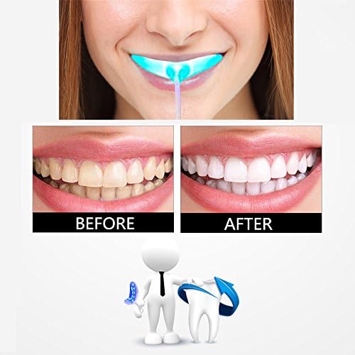 Teeth Whitening Kit - Professional Teeth Whitening Accelerator with Teeth Whitening Strips &amp; Teeth Whitening Gel for iPhone, Android and USB - Remove Teeth Stains and Whiten Teeth Faster Hi Smile