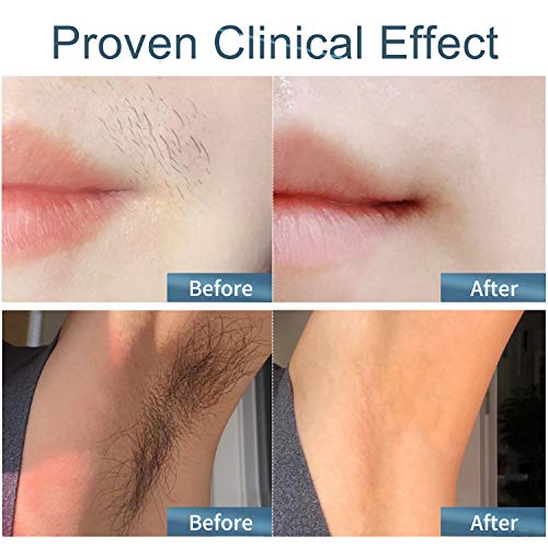 IPL Hair Removal Device Veme 500000 Flashes ICE Cooling Home Use Hair Remover for Face, Armpits, Bikini Line, Legs