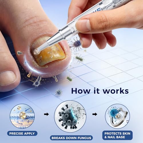Athlete‘s Foot & Toenail Fungus Treatment Pen – Extra Strength Antifungal with 25% Undecylenic Acid, Maximum OTC, Precision Applicator for Itch Relief & Nail Care, Between Toes, 3 Pens + 5 Files