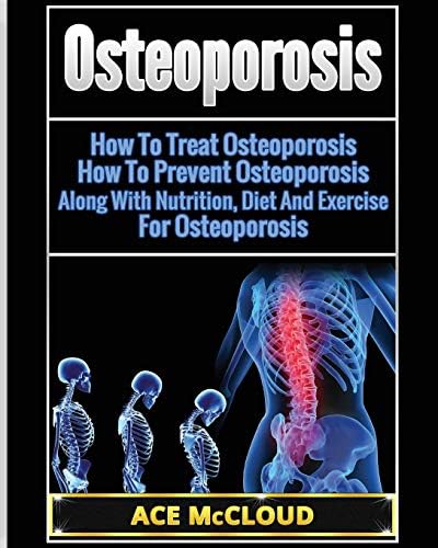 Osteoporosis: How To Treat Osteoporosis: How To Prevent Osteoporosis: Along With Nutrition, Diet And Exercise For Osteoporosis (Reverse or Prevent Bone Loss From Osteoporosis All)