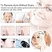 Blackhead Remover， Comedone Blackhead Extractor Tweezers Acne Removal kit by Aignis