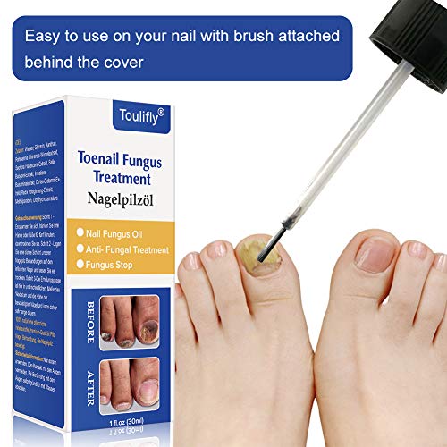 5 Natural+Treatment+Maximum+Strength+Solution