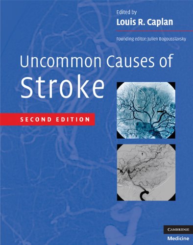 Uncommon Causes of Stroke by Louis R. Caplan