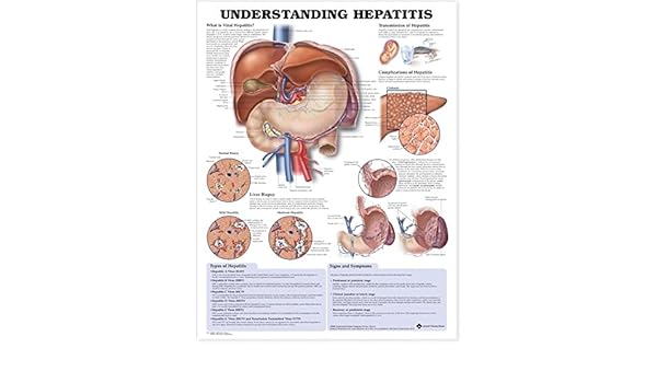 Understanding Hepatitis Anatomical Chart Not Available 9781587794186 Amazon Com Books