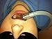 Kona Adapter 2.0 Kit - Attach **Isolite** Dental Mouthpieces Directly to your HVE valve
