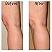 5PCS X Spider Vein Varicose Veins Cream For Leg