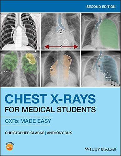 Amazon.com: Chest X-Ray Made Easy E-Book eBook : Corne MA, PhD, MB