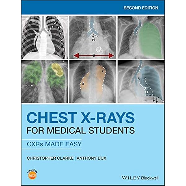 Amazon.com: The Chest X-Ray: A Survival Guide eBook : de Lacey