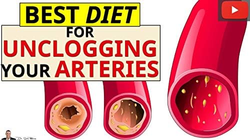 Best Diet For Removing Calcium Deposits & Plaque Buildup From Your Arteries