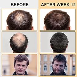Minoxidil for Men 5% Minoxidil Foam for Hair growth