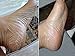 Soft Soles Foot Exfoliating Mask, Revitalizes Feet, Removes Calluses, Makes Feet Baby Smooth