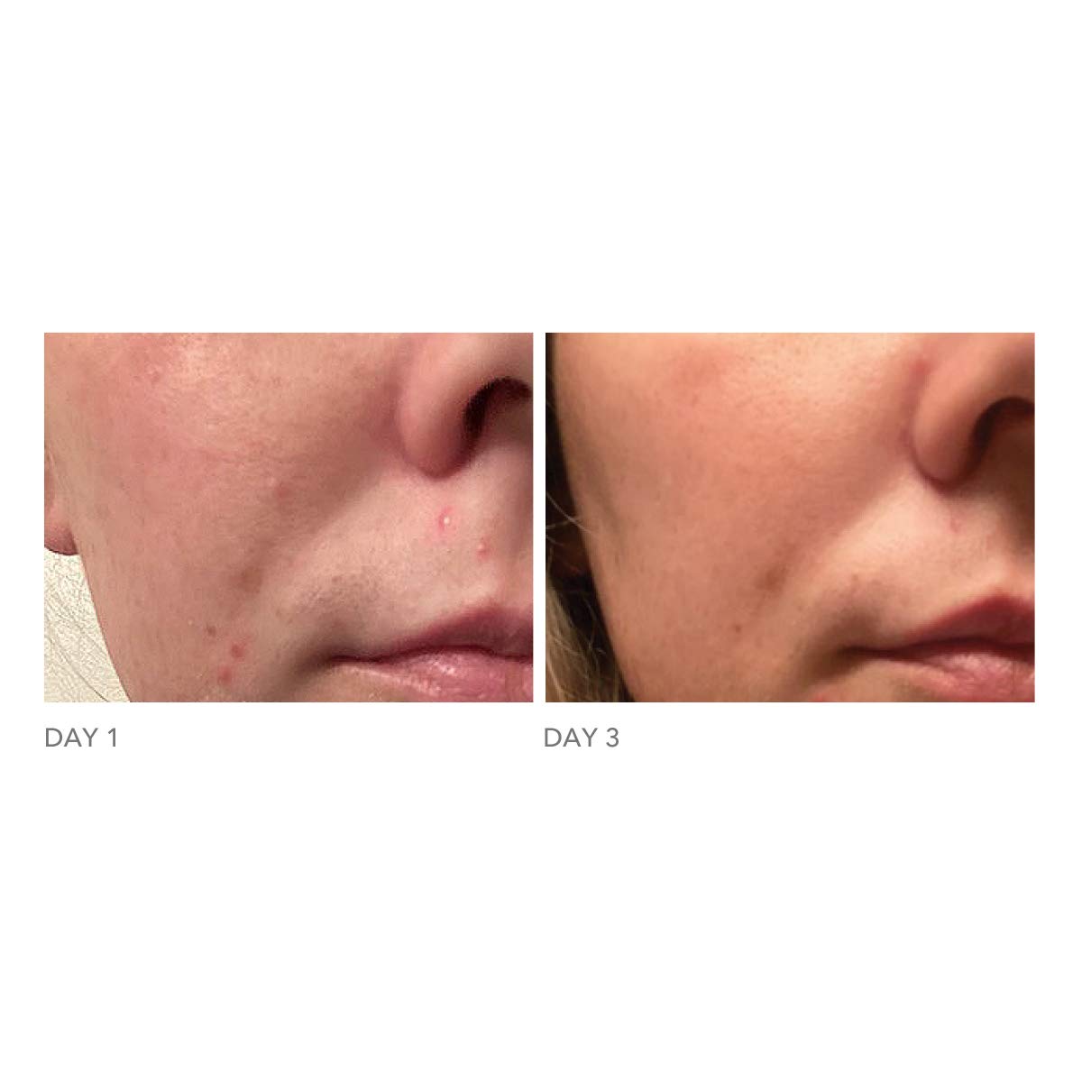 breakout clearing gel