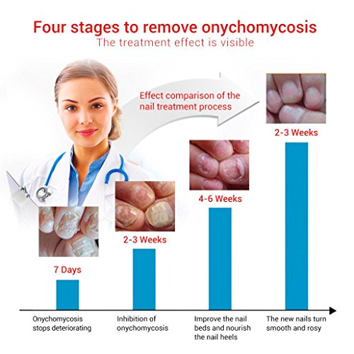 Nail Toenail Fungus Treatment, Fungus Stop Effective Anti Against Nail Fungus Solution Set (15ml)