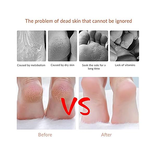 Foot-Scraper-Callus-Shaver-Stainless-Steel-Foot-Rasp-Dead-Hard-Skin-Remover-Foot-File-Sets-for-Heel-Callus-Cracked-Dry-Skin-with-10-Blades-for-Hand-Feet-Pedicure-Foot-Care-Tool-Silver Foot Scraper Callus Shaver - Stainless Steel Foot Rasp Dead Hard Skin Remover Foot File Sets for Heel Callus | Cracked…