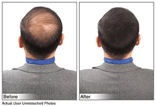 image for JUVEKER Hair Building Fibers Hair Loss Concealer for Men & Women - 28 