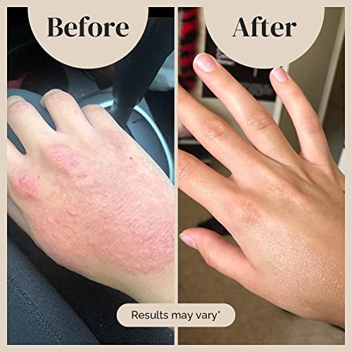 Puriya National Eczema Association Accepted Cream, Dry Itchy Skin