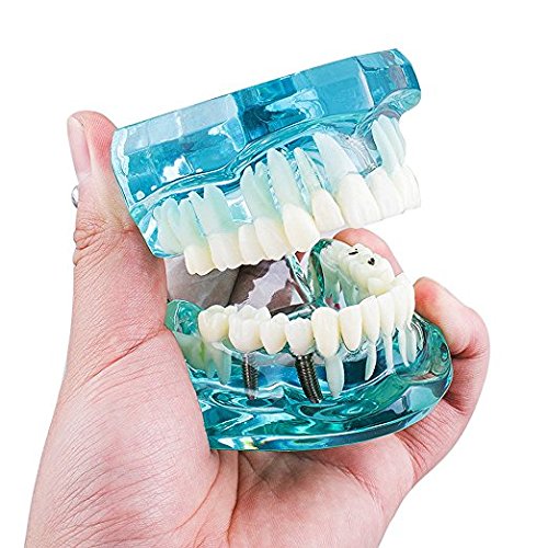 Zgood Dental Study Tooth Model Adult Pathological Teaching Teeth Model