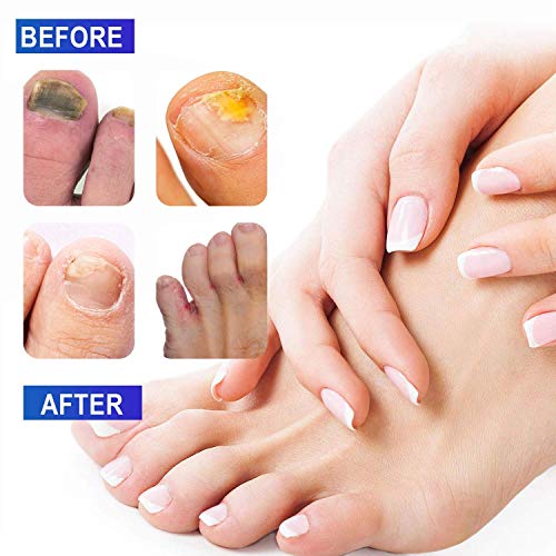 Votala Nail Fungus Treatment, Powerful Toenail Fungus Treatment, Anti