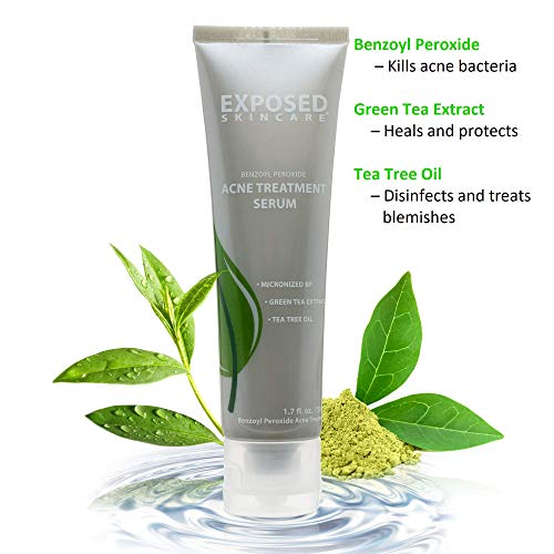 Exposed Skin Care Acne Treatment System (60 Day) 5 Piece Basic Kit Heals and Prevents Teen/Adult