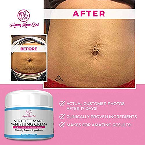 5 Stretch+Mark+Cream+Pregnancy+Alternative