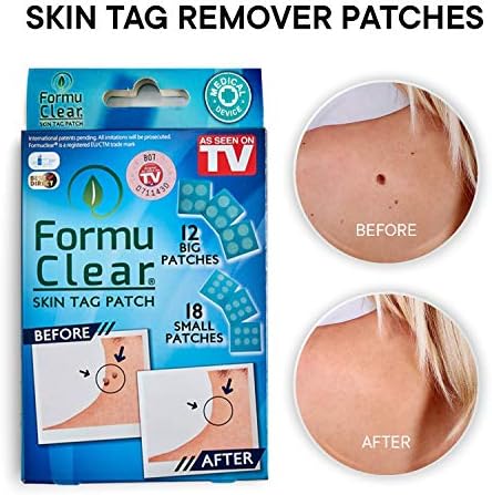 Skin Tag Remover Set (30 PCS), 12 Big Patch, 18 Small patch, Tags dries and fall away,Natural Ingredients, improved formulation skin tag remover