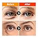 KARATICA I'M FILL PATCH, for wrinkles and fine lines, Hyaluronic acid, Micro-needle Patch, Dark Circle Puffiness, Moisturizing, Eye filler patch, 5 pairs