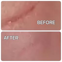 Amazon.com : BEST Scar Removal Cream Treatment: Advanced New & Old ...